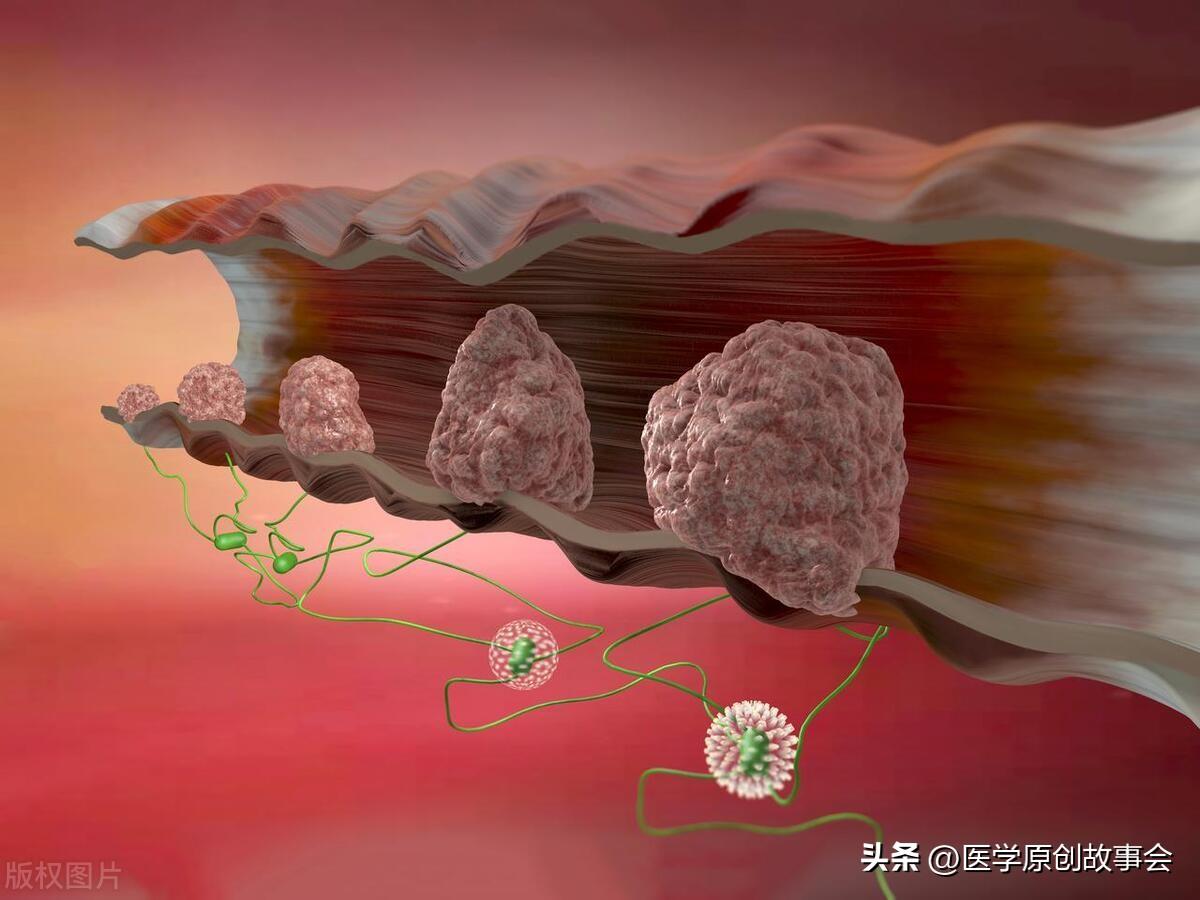 醫生忠告：腸息肉不想變腸癌，4種東西盡量少吃，再饞也要忍住