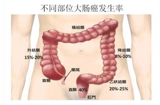 結腸癌肝轉移必死 
