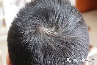 怎么治療白頭發呢？