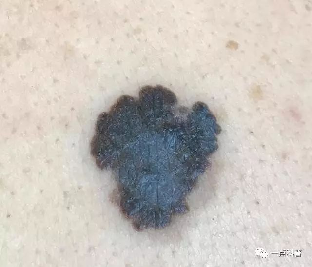 老年人身上不規則的黑斑，一定要警惕黑色素瘤的發生！