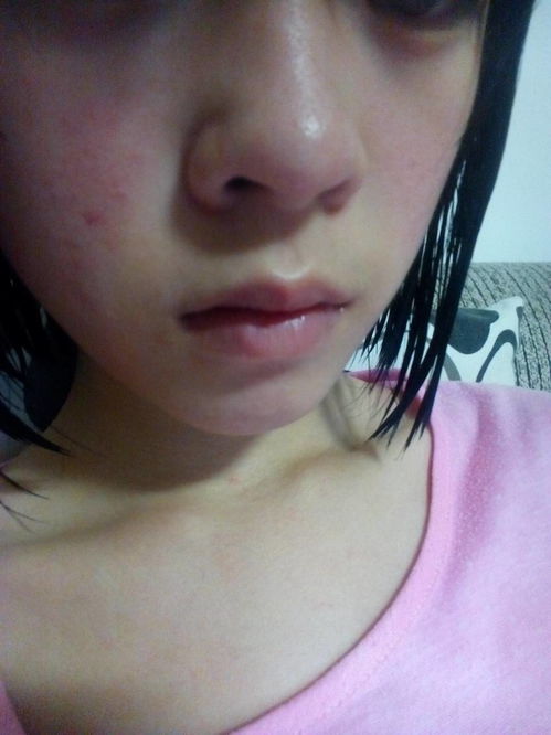 臉過敏快速消腫小妙招 臉是因為什么過敏呢