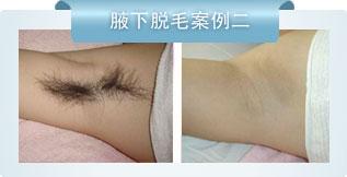 什么方法脫毛好