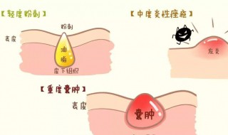怎樣處理青春痘 處理青春痘的方法