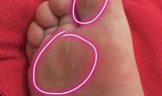 腳裂口子怎么辦 腳裂的護理方法有哪些