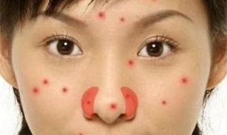 鼻子上長痘痘怎么辦？可以做好以下三點