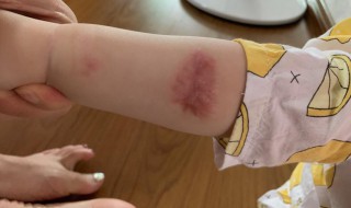 燙傷疤痕如何消除 如何消除燙傷疤痕